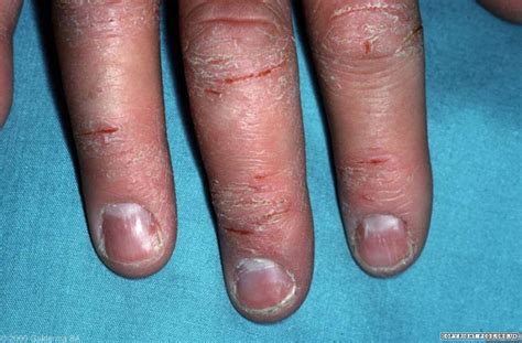 Hand eczema, hand dermatitis | Primary Care Dermatology Society | UK