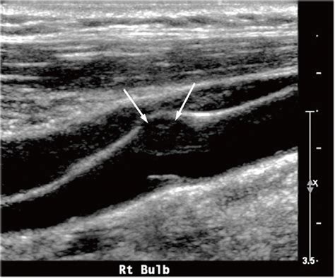 Ultrasound (US) example of an echolucent plaque. The US image shows a ...