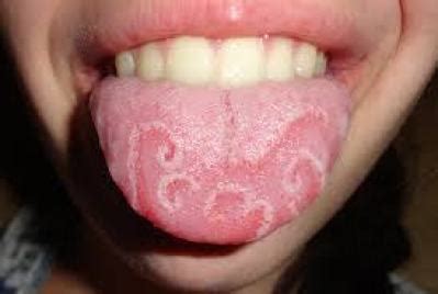 causes of sore tongue