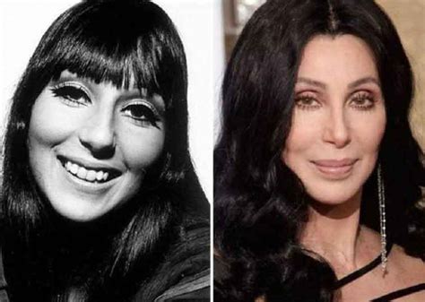 Cher plastic surgery 2