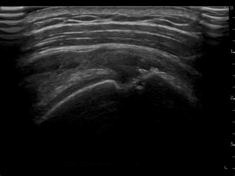 Supraspinatus full thickness tear | Ultrasound Cases