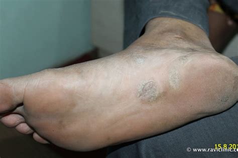 A case of Psoriasis at Feet – Homeo Energy