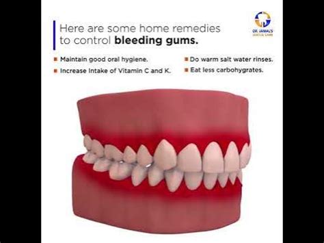 Bleeding Gums Home remedies By A Dentist | Masooro se Khoon ana #gumsbleeding #homeremedies # ...