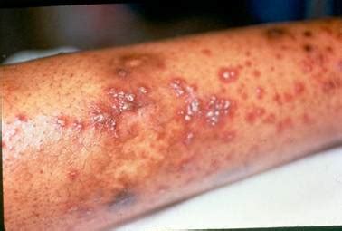 Henoch-Schönlein Purpura • Johns Hopkins Vasculitis Center