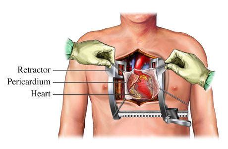 Open Heart Surgery Diagram - For Patients & Caregivers