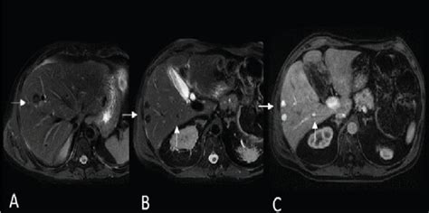 (a) Pretreatment scans (MRI). Axial T2 WI (A, B) and postcontrast... | Download Scientific Diagram