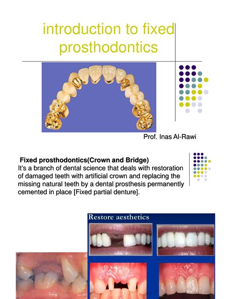 Introduction to fixed prosthodontics - introduction to fixed ...