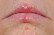 Treatment for Cold Sores below the Lower Lip Line That Work Fast - Cold Sores Cured