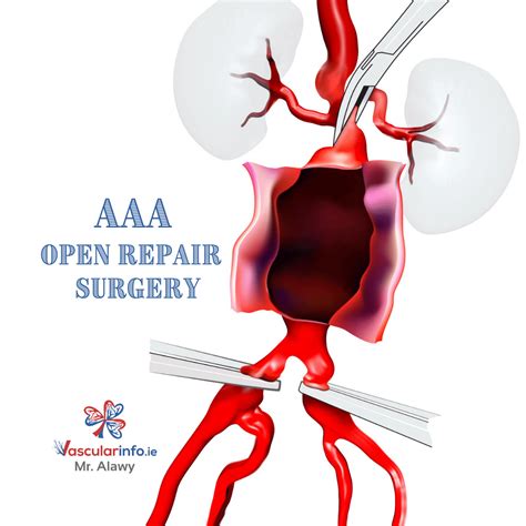 Endovascular AAA Repair - Vascular Info