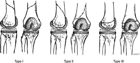 TKA Periprosthetic Fracture - Recon - Orthobullets