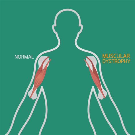 What is Muscular Dystrophy and How Does Muscle Therapy Help?