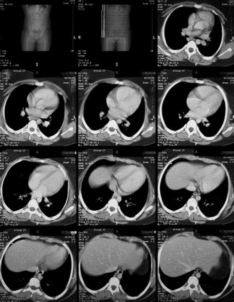 Barium contrast ct scan - Answers on HealthTap