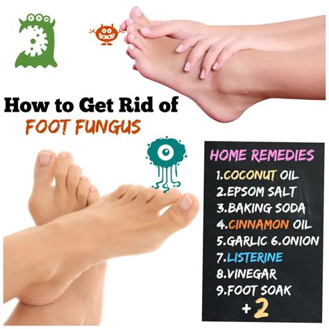 How to Get Rid of Foot Fungus #11 Athlete's Foot to Happy Feet