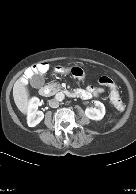 Annular pancreas | Radiology Reference Article | Radiopaedia.org