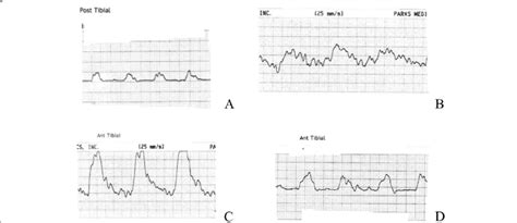 Examples of monophasic waveforms including decreased amplitude (A ...