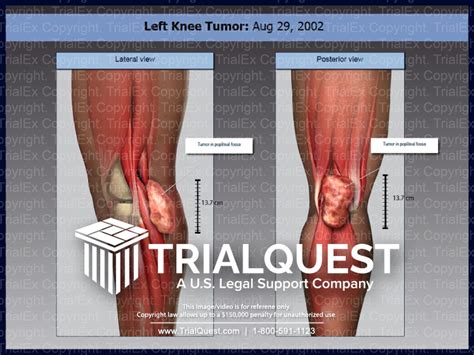 Left Knee Tumor - TrialExhibits Inc.