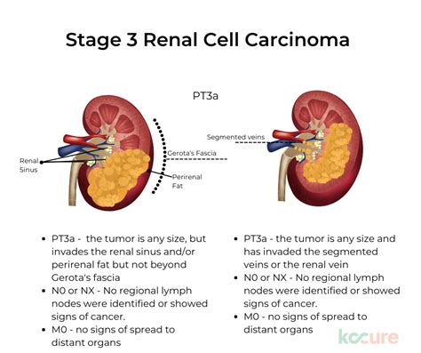 Renal Cell Carcinoma Staging