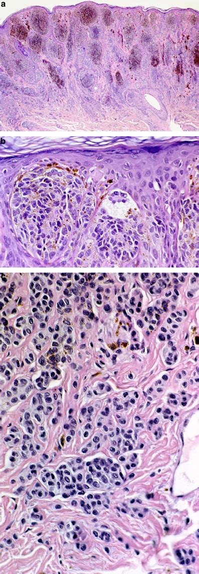 Dysplastic Nevus Histology