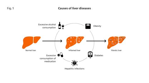 Liver fibrosis: Patients can be at risk of death even without exhibiting symptoms