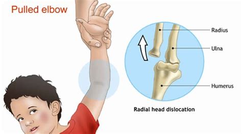 nursemaid's elbow symptoms Archives - SAMARPAN PHYSIOTHERAPY CLINIC ...