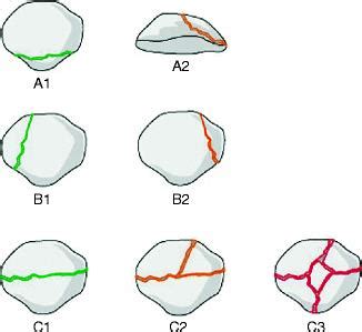 Patella Fracture - Trauma - Orthobullets