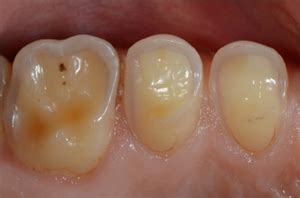 What are wear facets on teeth? | News | Dentagama