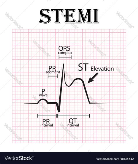 Myocardial Infarction Ecg : PPT - ECG Changes in Acute Myocardial ...