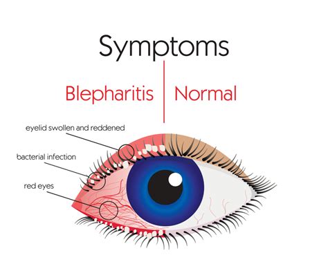 Blepharitis: Symptoms and Treatment | Fort Lauderdale Eye Institute