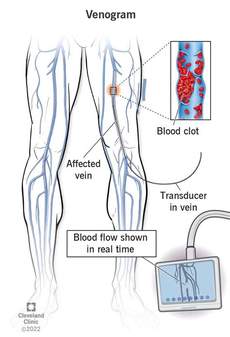 Venogram: Procedure Details & Recovery