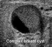 Enlarging Breast Cyst Factory Sale | centralcountiesservices.org