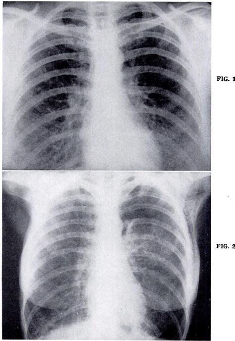 Figure 2 from Hamman-Rich syndrome (diffuse interstitial pulmonary fibrosis). | Semantic Scholar