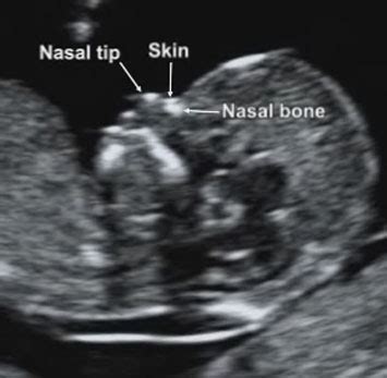 Nasal Bone Measurement Ultrasound