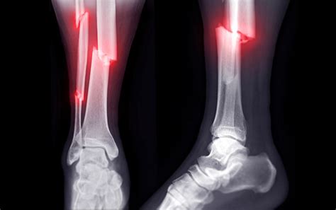 Compound Fractures X Ray