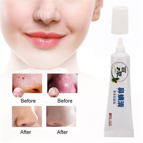 OTVIAP 15g Efficient Mites Remove Red Nose Blackhead Rosacea Cream ...