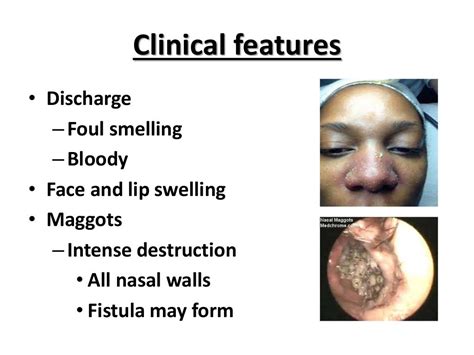 Nasal Myiasis