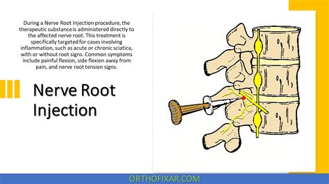 Nerve Root Injection - Full Review | OrthoFixar 2024