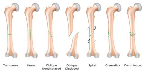 Comminuted Fracture | Causes, Symptoms And Recovery