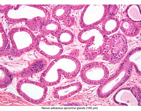 Pathology Outlines - Nevus sebaceus of Jadassohn