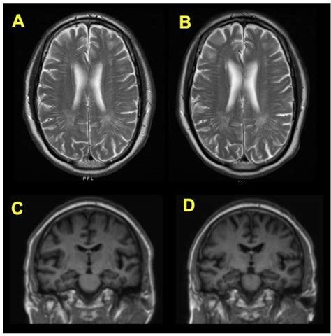 In axial T2 weighted MRI images, the periventricular white matter... | Download Scientific Diagram