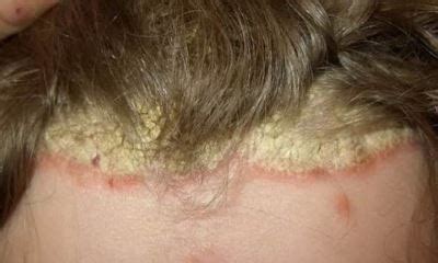 Scalp psoriasis symptoms pictures, mild scalp psoriasis pictures, what ...