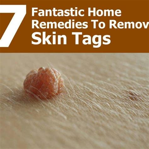 Skin tags | Remove dark spots, Skin tag, Remedies