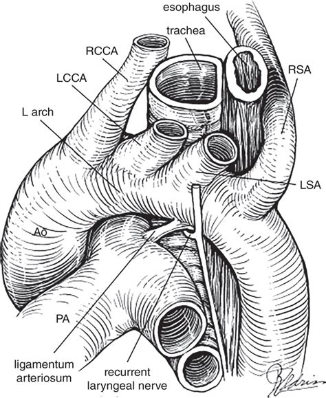 Vascular Rings and Pulmonary Artery Sling | Thoracic Key