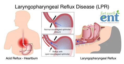 Laryngopharyngeal Reflux Disease (LPR) | Fort Worth ENT & Sinus