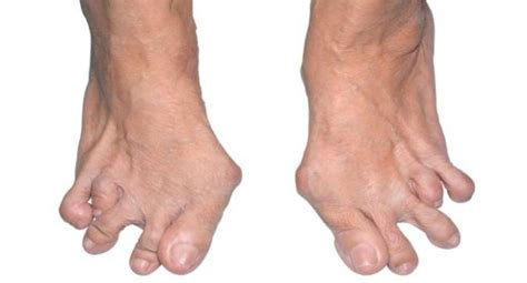 How rheumatoid arthritis affects the foot and ankle | TheHealthSite.com