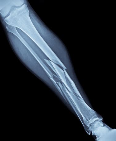 Broken Leg Xray Stock Photo - Download Image Now - iStock