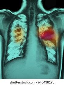 Pulmonary Tuberculosis Chest Xray Interstitial Infiltration Stock Photo 645438193 | Shutterstock