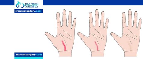 Wrist Surgery Scar - Iranian Surgery