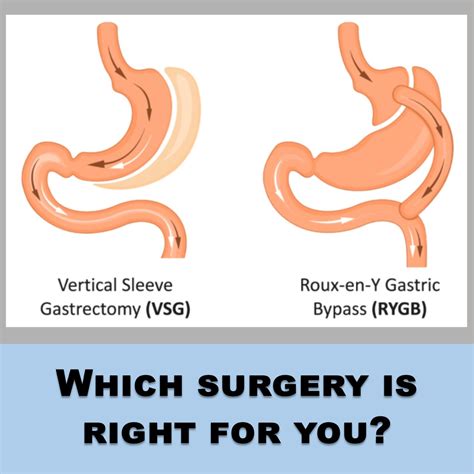 Gastric Bypass vs. Gastric Sleeve Surgery: Which weight loss procedure ...