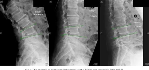 Figure 3 from Slump sitting X-ray of the lumbar spine is superior to ...