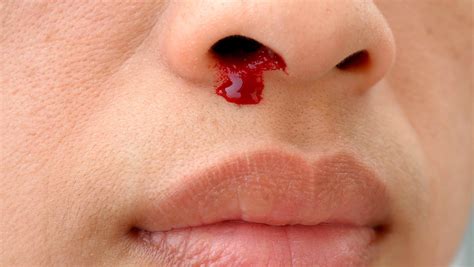 Scabs in Nose Causes: Painful, Bloody, Treatment, Home Remedies - LightSkinCure